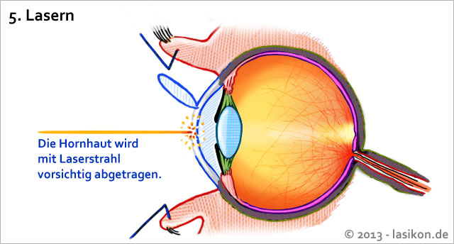 Augen lasern lassen bedeutet die Hornhaut mit dem Laser abzutragen