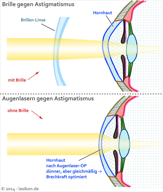 Augenlasern bei Astigmatismus