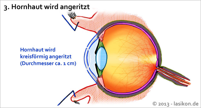 Vor dem Lasern der Augen wird die Hornhaut angeritzt