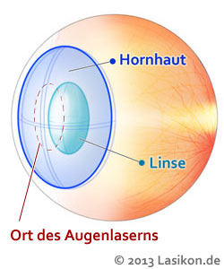 Lasik Erfahrungen mit Augenkliniken in Nürnberg: Hohe Erfolgsquoten mit guten Spezialisten