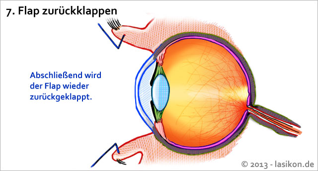 Abschluss der Augen-Laser-OP: Die offene Cornea wird mit dem Flap verschlossen
