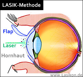 LASIK: Flap & Laser