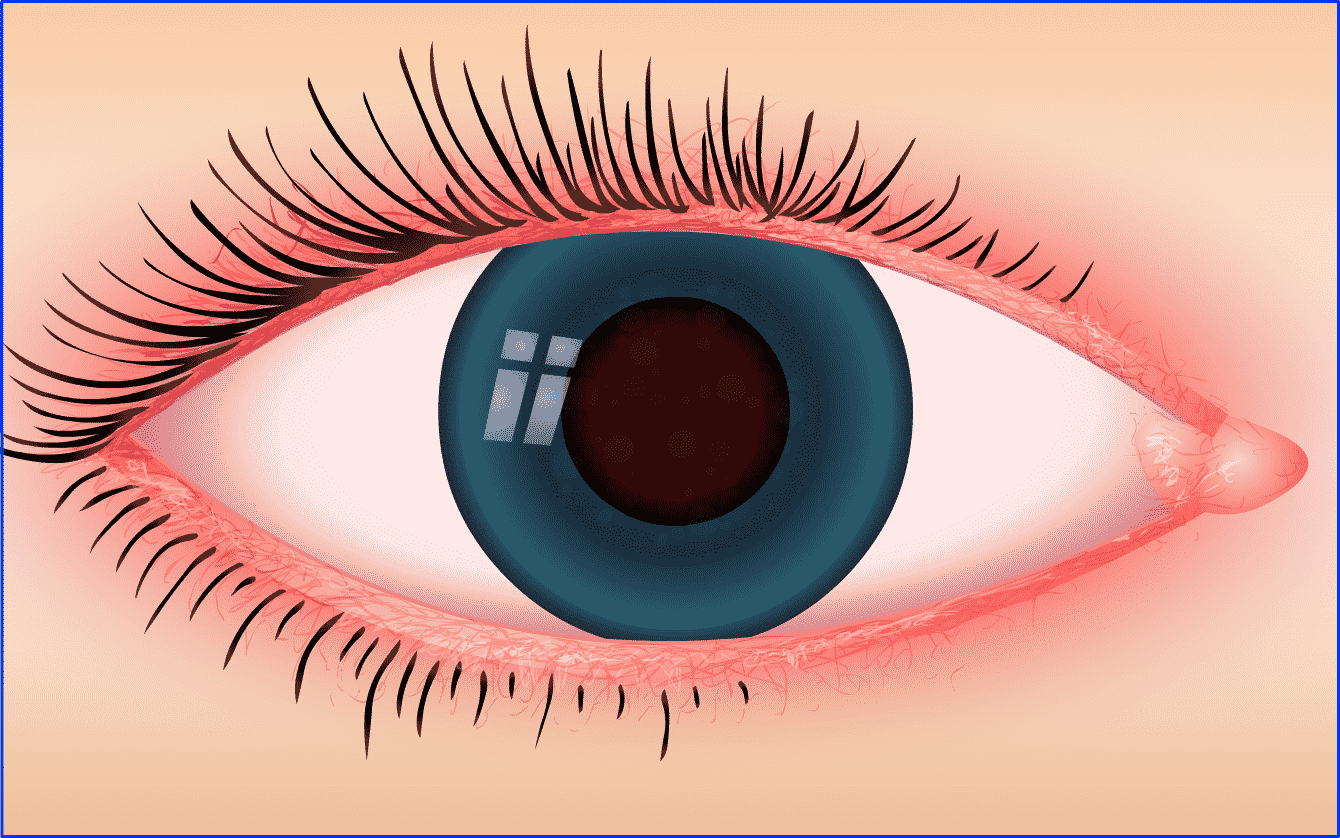 Lidrandentzündung: Ursachen und Behandlung bei Entzündungen der Augenlider