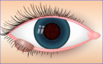 Augenlidtumor: Talgdrüsenkarzinom Wucherungen durch OP entfernen
