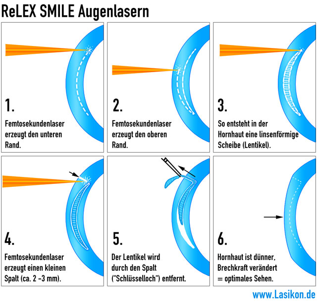 ReLEx SMILE Augenlasern