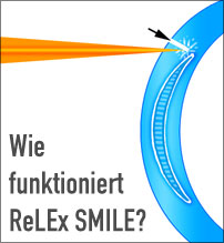 Relex Smile: Erfahrungen mit der neuen Laser Methode